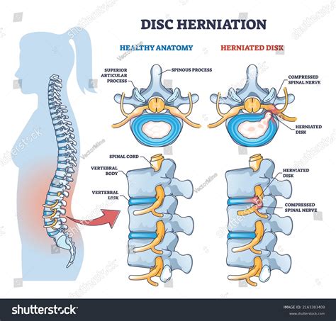 Disc Herniation Spine Nerve Compression Vs Stock Vector (Royalty Free ...