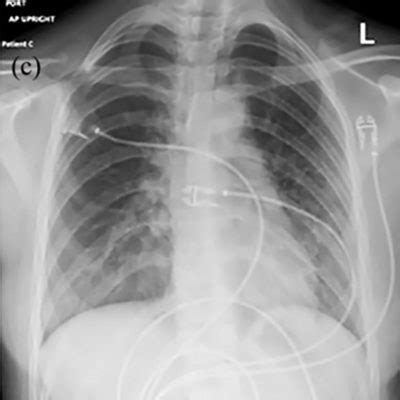 Breathing Problems in Teens: COVID-19 or Vaping Lung Injury?