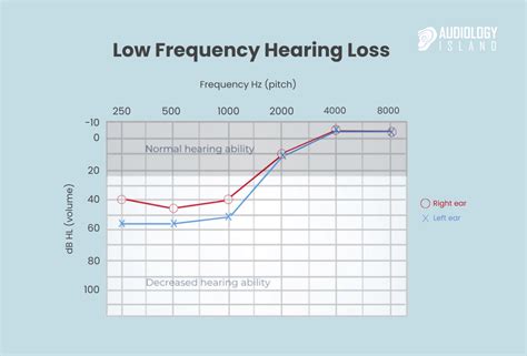 Low Frequency Hearing Loss: Symptoms and Treatment - Audiology Island