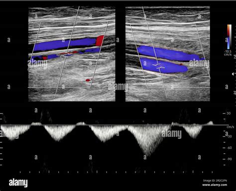 Ultrasound Diagnosis Of Lower Extremity Venous Thrombosis