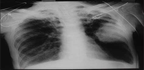 Sarcomatoid carcinoma of the lung : Lung India