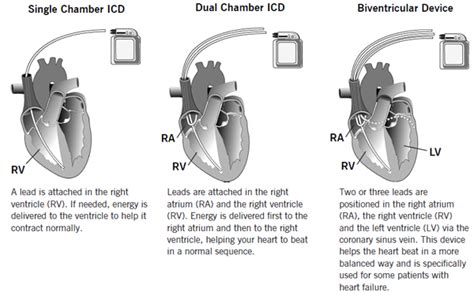 Implantable Cardioverter Defibrillator - Hamilton Cardiology Associates ...