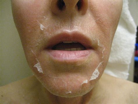 Chemical Peels for Acne and Anti Aging: 30% TCA at-home Peel