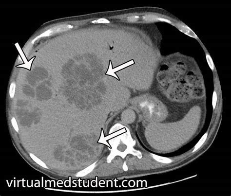 Liver abscess, pyogenic