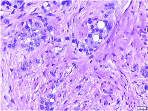 Histological image from the biopsy of the omental caking showing poorly... | Download Scientific ...