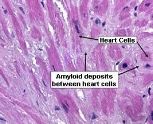 AL Primary Amyloidosis | Stanford Health Care