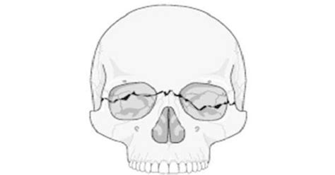 Fracture of the facial bones-Nose,Maxilla,Mandible,Zygomatic - New