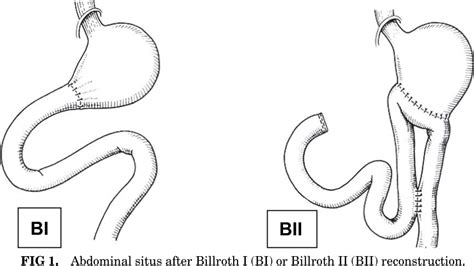 Preserving duodenal passage for bone mineralization: Billroth I versus Billroth II ...