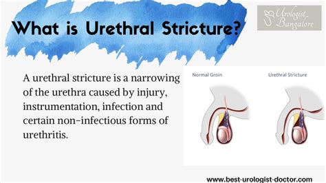 Urethral Stricture Treatment | Best Treatment for Urethral Stricture