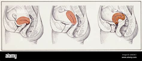 Positions of the uterus: normal, retroflexion and retroversion, illustration Stock Photo - Alamy