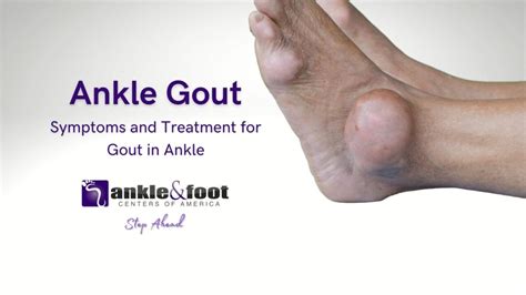 Ankle Gout - Causes, Symptoms, and Treatment in Nashville