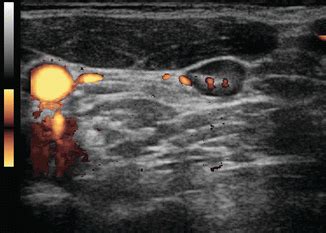 Ultrasound and Mapping of Neck Lymph Nodes | Radiology Key