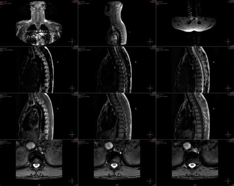 MRI Differentiates Low-Grade Bladder Tumors - Renal and Urology News