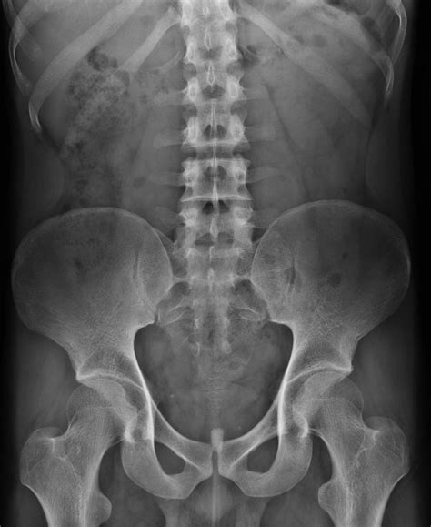 NORMAL HIP XRAYS | buyxraysonline