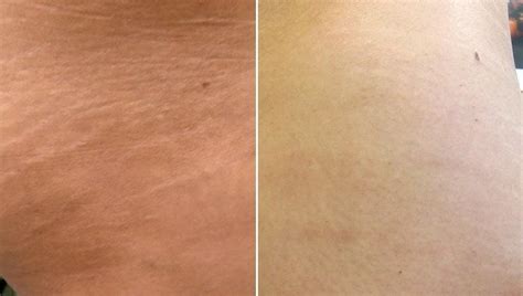 Stretch Marks Removal Treatment Ealing, London - SSS Clinic Ealing