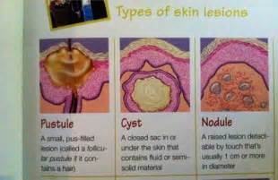 Types of Lesions - Pustule, Cyst, Nodule | Nclex, Nclex rn, Nursing exam