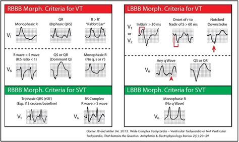 ECG Rhythms: Aberrancy