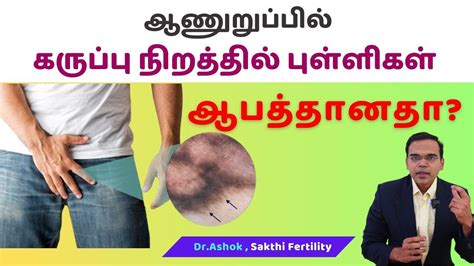 Penile melanosis: Causes, treatment | ஆணுறுப்பில் கருப்பு நிறத்தில் புள்ளிகள் ஆபத்தானதா? - YouTube