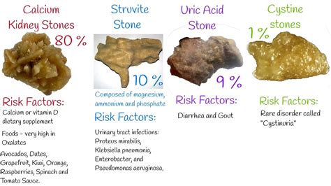 Kidney Stones - Types and Causes of Kidney Stones. Symptoms and ...