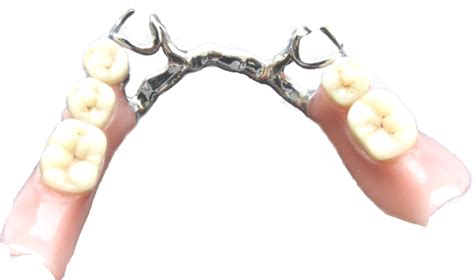 Clasp A Device that retains a removable partial denture to stationary ...