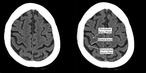 Radiological Anatomy: Central Sulcus - Stepwards