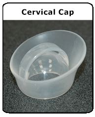 Birth Control: Cervical Caps (for Parents) - Rady Children's Hospital (XML)