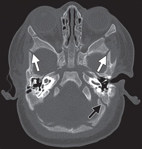 CT of Normal Developmental and Variant Anatomy of the Pediatric Skull ...