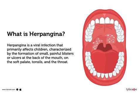 Herpangina: Causes, Symptoms & Treatment