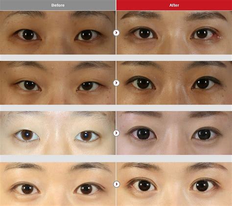 Double Eyelid Surgery Before And After Photos - Korean Plastic Surgeries