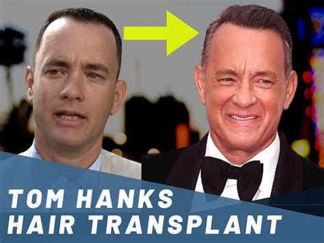 Tom Hanks Hair Transplant - Hair Loss & Technical Analysis