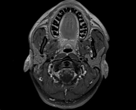 MRI Soft tissue neck axial T1 fat sat post contrast images