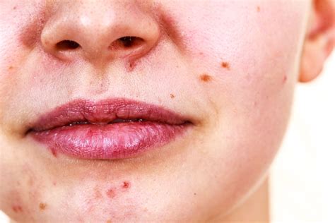 Benzoyl Peroxide Treatment for Acne