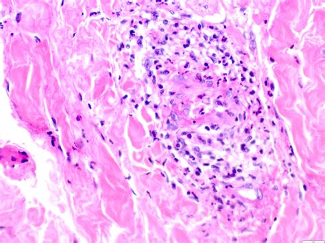 Leukocytoclastic Vasculitis Histology