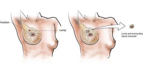 Lumpectomy | Baylor Medicine