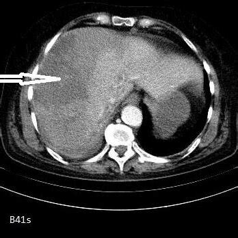 -Right lobe liver laceration in segment 6 | Download Scientific Diagram