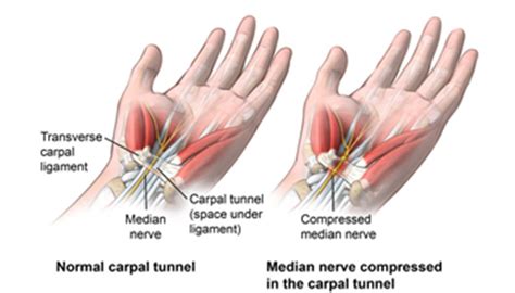 Carpal Tunnel Syndrome | Johns Hopkins Medicine