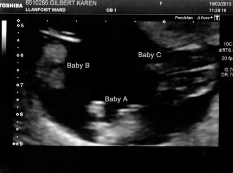 Identical Triplets Ultrasound