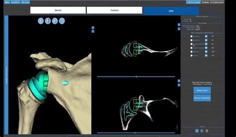 Tornier Perform Humeral Stem Planning in BLUEPRINT™ 3D Planning Software | VuMedi