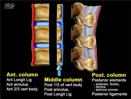 Posterior Neural Arch Fracture