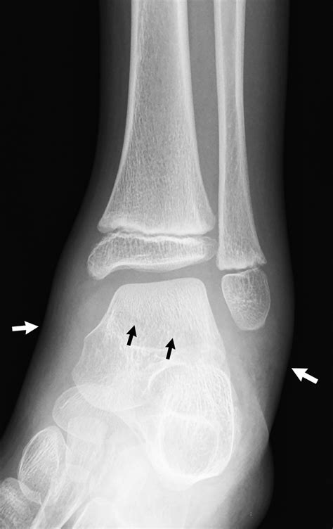 My achin’ feet: Talus fracture | Radiology Key