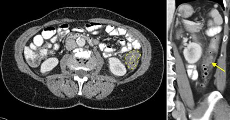 Acute diverticulitis - CT - Radiology at St. Vincent's University Hospital