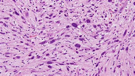 Sarcomatoid Carcinoma of the Lung