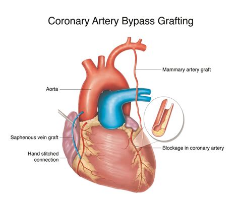 Liverpool Heart and Chest Hospital | Coronary Artery Bypass Grafting