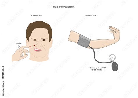 Two neurological test to evaluate the presence of hypocalcemia ...