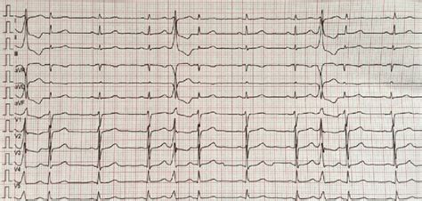 12-lead ECG demonstrates monomorphic premature ventricular contraction ...