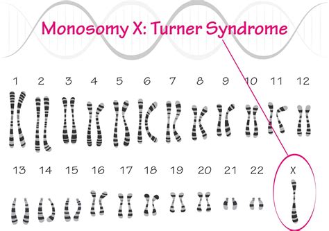 Turner Syndrome Karyotype Monosomy X 7818638 Vector Art at Vecteezy