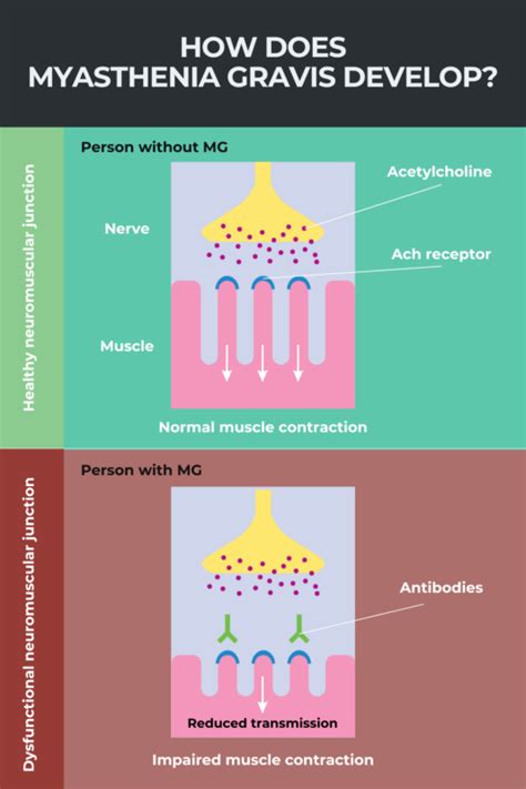 Myasthenia gravis: Causes, types, and more | Myasthenia Gravis News