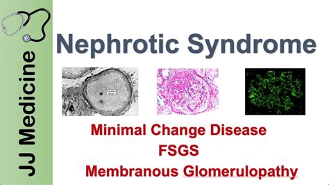 Nephrotic Syndrome | Clinical Presentation, Causes and Treatment - YouTube