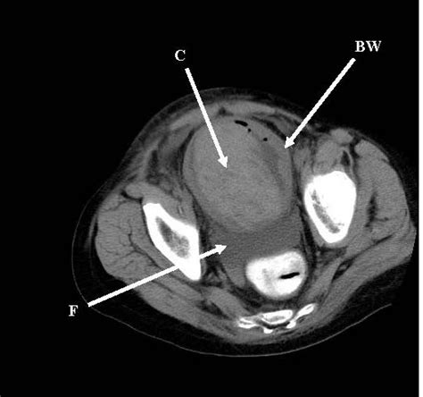 Hemorrhagic cystitis in pediatric patients: Case presentation with review of the literature and ...