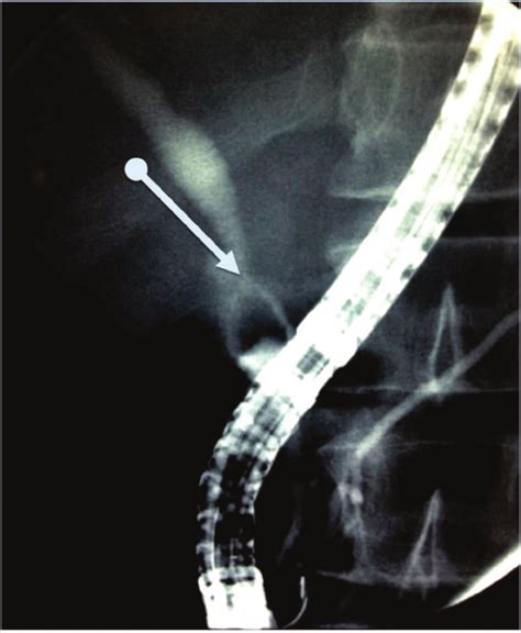 Endoscopic retrograde cholangiopancreatography. The arrow indicates a ...